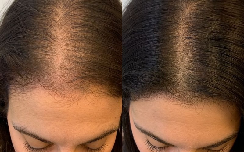 Saçlar Neden Seyrelir? Saç Dökülmesi ve Yoğunluk Kaybı Neden Oluşur?