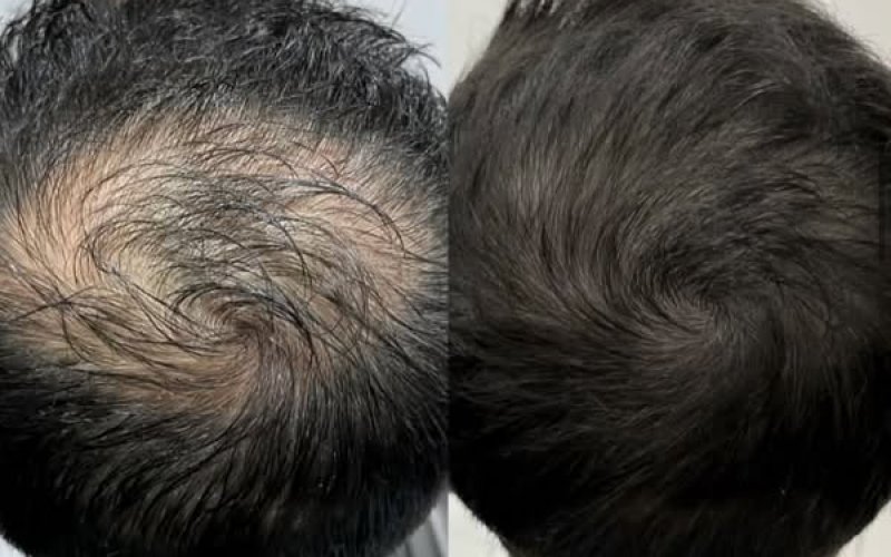 Saç Çoğaltma Nedir? Nasıl Yapılır, Kimler İçin Uygundur? | Ankara Keçiören